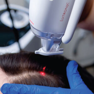 Laser Tulowy Lutronic Ultra na skóre głowy