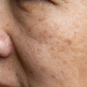 Laserowe usuwanie przebarwień